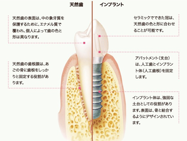 インプラント