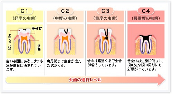 虫歯治療