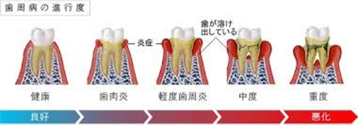 歯周病治療