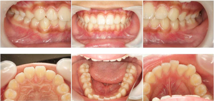 12歳女の子の歯の写真